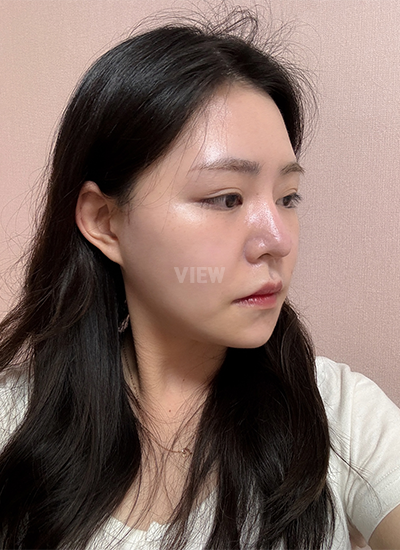 รีวิวครบ 21 วันของการผ่าตัดโครงหน้า, รีวิวครบ 14 วันของการผ่าตัดแก้จมูก, การดูแลหลังผ่าตัด 3อาทิตย์