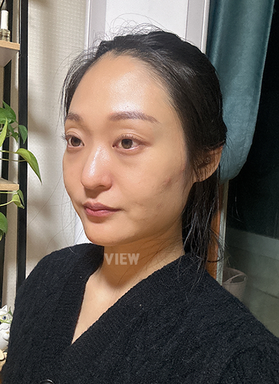 รีวิวเกลี่ยไขมันใต้ตา, รีวิวศัลยกรรมจมูก, การดูแลหลังผ่าตัด