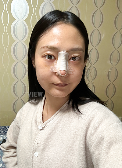 รีวิวเกลี่ยไขมันใต้ตาครบ 3วัน, รีวิวศัลยกรรมจมูก ครบ 3วัน, การดูแลหลังผ่าตัด, รีวิวหลังผ่าตัด