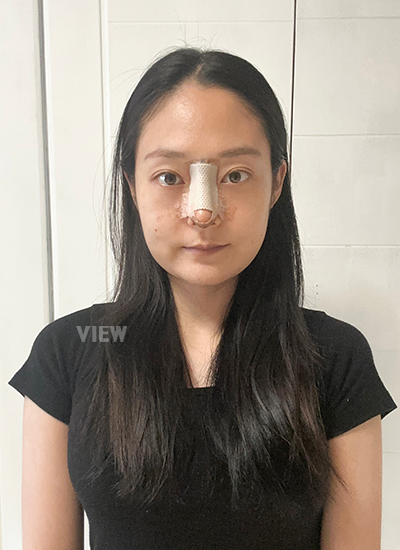 รีวิวเกลี่ยไขมันใต้ตาครบ 7 วัน, รีวิวศัลยกรรมจมูก ครบ 7 วัน, การดูแลหลังผ่าตัด, รีวิวหลังผ่าตัด
