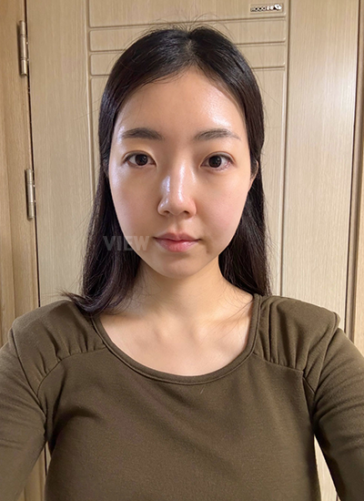 รีวิวร้อยไห, ดูดไขมันหน้า, ฉีดไขมันหน้า, โบทอกซ์ ,หน้าเด็ก, โรงพยาบาลศัลยกรรมเกาหลี, โรงพยาบาลวิว