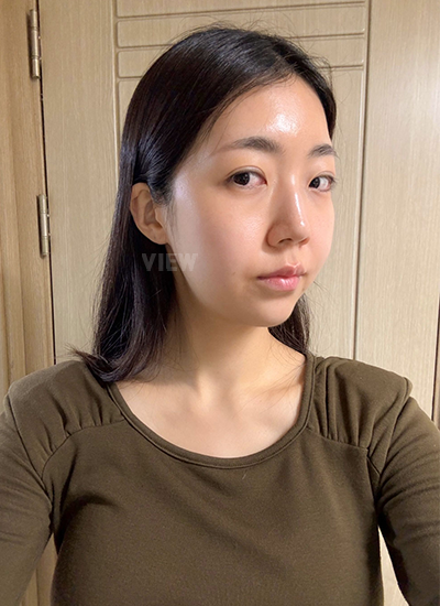 รีวิวร้อยไห, ดูดไขมันหน้า, ฉีดไขมันหน้า, โบทอกซ์ ,หน้าเด็ก, โรงพยาบาลศัลยกรรมเกาหลี, โรงพยาบาลวิว