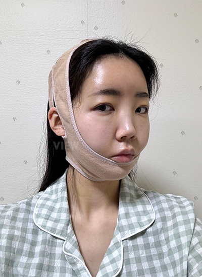 รีวิวร้อยไห, ดูดไขมันหน้า, ฉีดไขมันหน้า, โบทอกซ์ ,หน้าเด็ก, โรงพยาบาลศัลยกรรมเกาหลี, โรงพยาบาลวิว