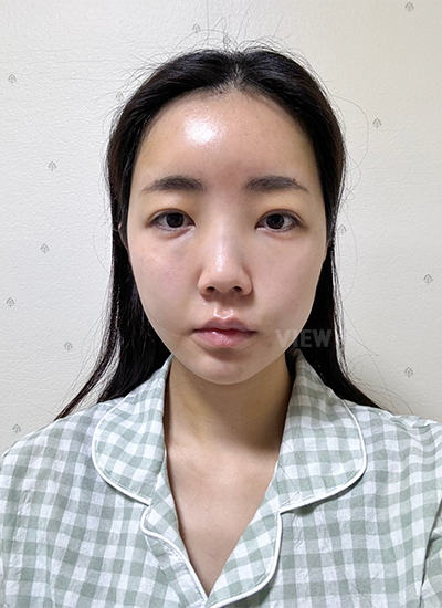 รีวิวร้อยไห, ดูดไขมันหน้า, ฉีดไขมันหน้า, โบทอกซ์ ,หน้าเด็ก, โรงพยาบาลศัลยกรรมเกาหลี, โรงพยาบาลวิว