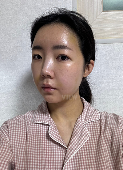 รีวิวร้อยไห, ดูดไขมันหน้า, ฉีดไขมันหน้า, โบทอกซ์ ,หน้าเด็ก, โรงพยาบาลศัลยกรรมเกาหลี, โรงพยาบาลวิว