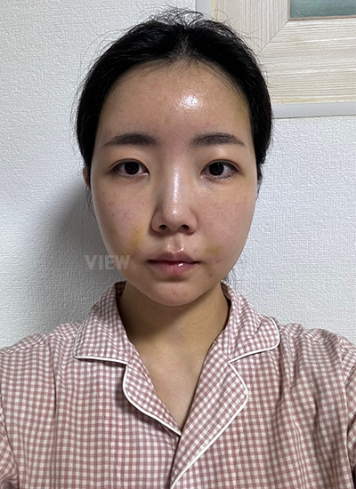 รีวิวร้อยไห, ดูดไขมันหน้า, ฉีดไขมันหน้า, โบทอกซ์ ,หน้าเด็ก, โรงพยาบาลศัลยกรรมเกาหลี, โรงพยาบาลวิว