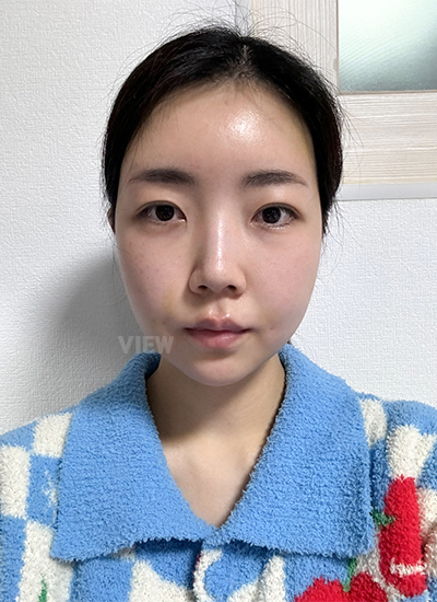 รีวิวร้อยไห, ดูดไขมันหน้า, ฉีดไขมันหน้า, โบทอกซ์ ,หน้าเด็ก, โรงพยาบาลศัลยกรรมเกาหลี, โรงพยาบาลวิว