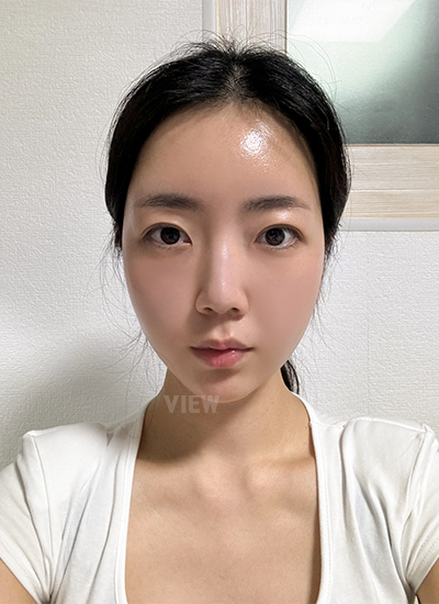 รีวิวร้อยไห, ดูดไขมันหน้า, ฉีดไขมันหน้า, โบทอกซ์ ,หน้าเด็ก, โรงพยาบาลศัลยกรรมเกาหลี, โรงพยาบาลวิว