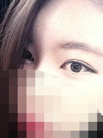 [Eye correction + cataract] Choi Yoo-jin