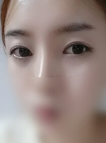 [Non-incision ptosis correction + cataract] Tak Chun-Won