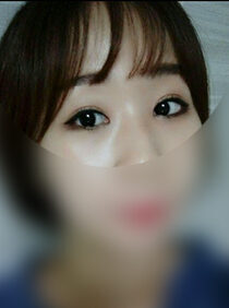 [Non-incision eyelid correction + front slit + posterior slit + lower slit] Kim Eun-ae