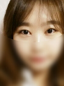 [Eye correction + cataract] Yeeun Choi