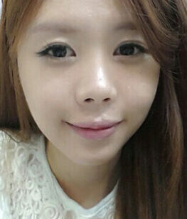 [Natural V line + cheekbone reduction] Park Hyun-young