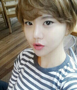 [Natural V line + cheekbones + T.O.P nose surgery] Choi Young-sun