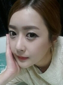 [Natural V-line + cheekbone reduction + forehead implant + accu lifting (cheek, double chin) + nasolabial filler] Gayeon Kim
