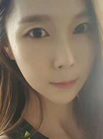 [Natural V-line + cheekbone reduction + chin surgery + nose surgery] Hana Yoon