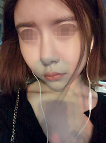 [rhinoplasty + nose reduction + facial fat grafting] Hana Bae