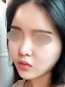 [rhinoplasty + osteotomy + ear cartilage] Baek Narae