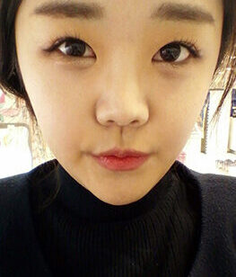 [Nano Yangak + Natural V Line + Cheeks Reduction] Kim Seon-young