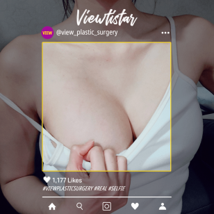 [Breast Augmentation] Jennie