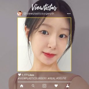[โครงหน้า 3 จุด + เสริมจมูก + ฉีดไขมันหน้า(ร่องแก้ม, หน้าผาก, ขมับ)] Park Sooyeon | Plastic Surgery Korea