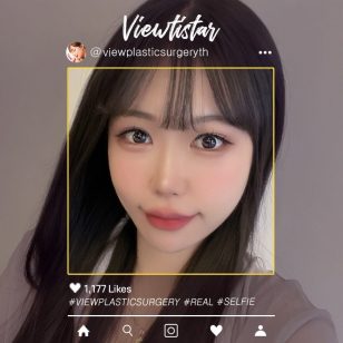 [แก้ชั้นตาสองชั้น + เปิดหัวตา] So yuna | Plastic Surgery Korea