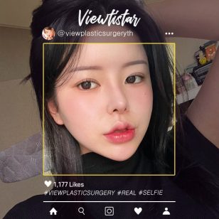 [ทำตาสองชั้น+เสริมจมูก+ฉีดไขมันหน้า+ดูดไขมันหน้า] Kang Yooseon | Plastic Surgery Korea
