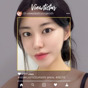 [จัดเรียงไขมันใต้ตา, ฉีดไขมันหน้า(เหนียง, แก้ม, กรอบหน้า )] Joe Yeseul | Plastic Surgery Korea