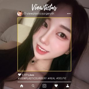 [ศัลยกรรมเปิดตา (เปิดหัวตา+เปิดหางตา+เปิดใต้ตา)] Seo seryeong | Plastic Surgery Korea
