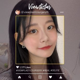 [ ปรับโครงหน้า, ทำตาสองชั้น, ร้อยไหม] Wang Jungsuan | Plastic Surgery Korea