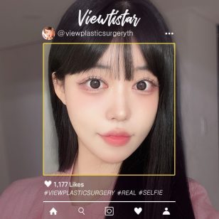 [ทำตาสองชั้น+ร้อยไหม+ดูดไขมันหน้า+ฉีดไขมันหน้า] Park Sehee | Plastic Surgery Korea