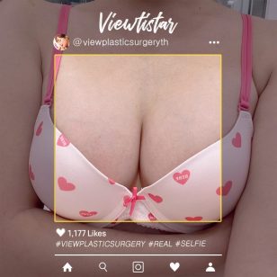 [ศัลยกรรมเสริมหน้าอก (Mentor boost)] Jeon Soyeon | Plastic Surgery Korea